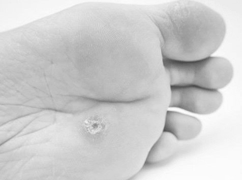 Viral Verrucae Removal Rickmansworth
