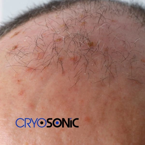 Access Seborrhoeic Keratosis removal from the comfort of your own home! Call us today in Rickmansworth