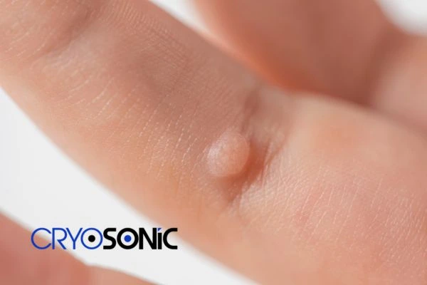 Contact Cryosonic today to learn more about us Rickmansworth now! Rickmansworth