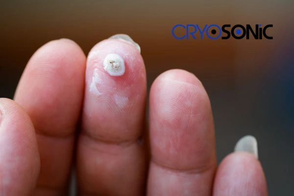 Learn more about us Rickmansworth at Cryosonic. Book in today! Rickmansworth