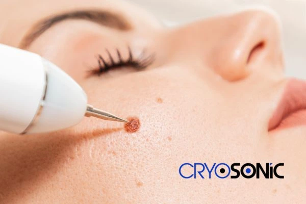 why choose us at Cryosonic for blemish removal? Find out more now Rickmansworth