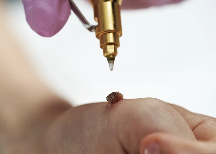 Cryopen For Children Bristol Rickmansworth