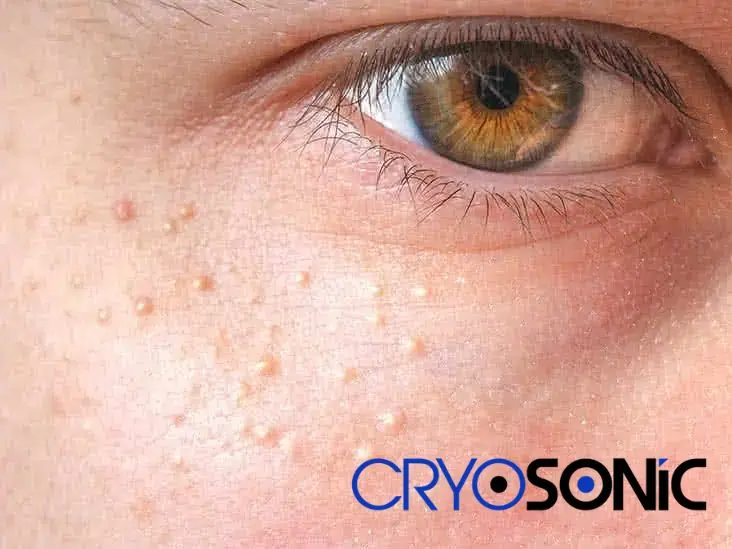 Cryosonic&rsquo;s CryoPen Approach to Milia Removal Rickmansworth Rickmansworth