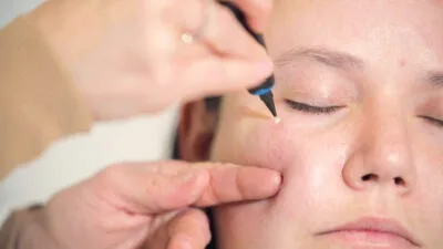Aftercare Advice Following Milia Removal in Rickmansworth
