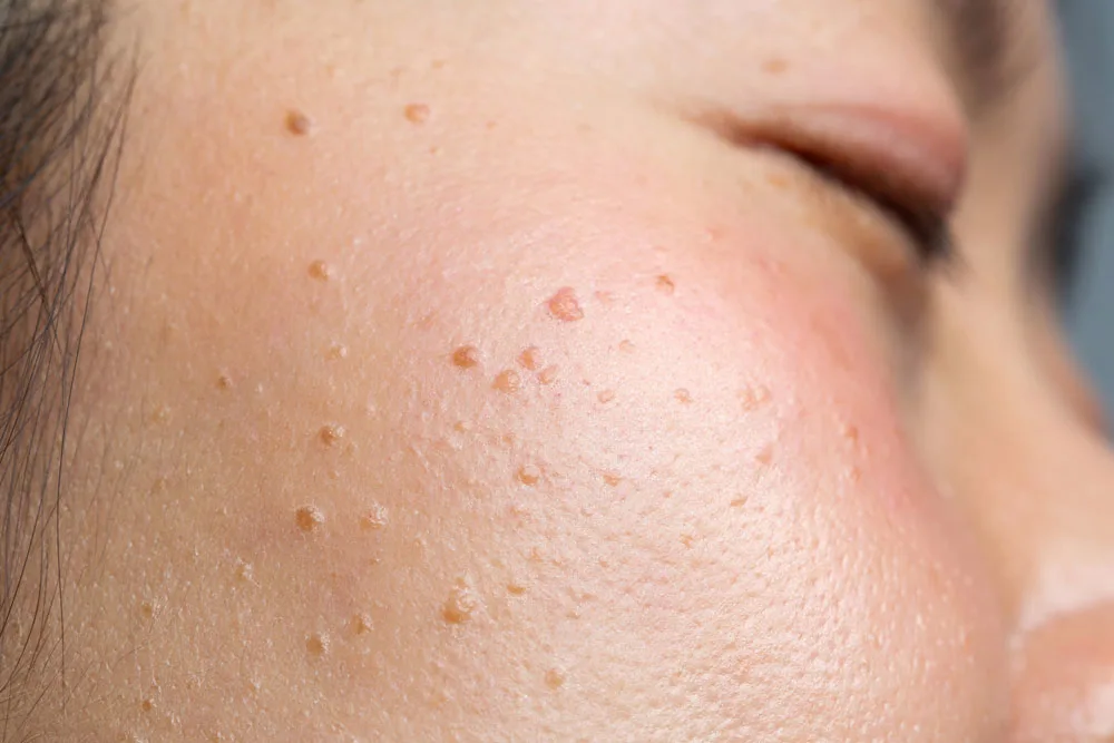Is cryopen Rickmansworth right for me? find out more today Rickmansworth