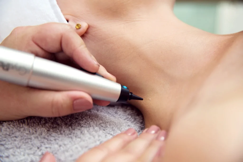 CryoPen Rickmansworth precisely treating Molluscum Contagiosum lesions, showing safe and effective removal for faster healing by Cryosonic Rickmansworth