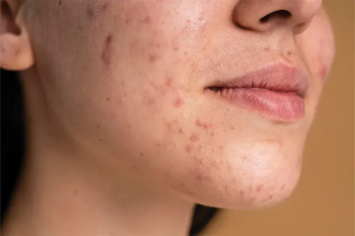 CryoPen precisely removing Skin Tags (fibroepithelial polyps), showing safe and effective treatment for smoother, clearer skin Rickmansworth