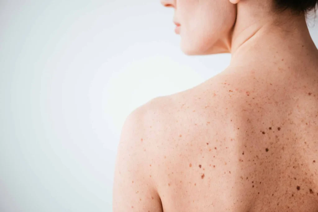 Sun Damage : Understanding UV Effects and Skin Repair Options Rickmansworth