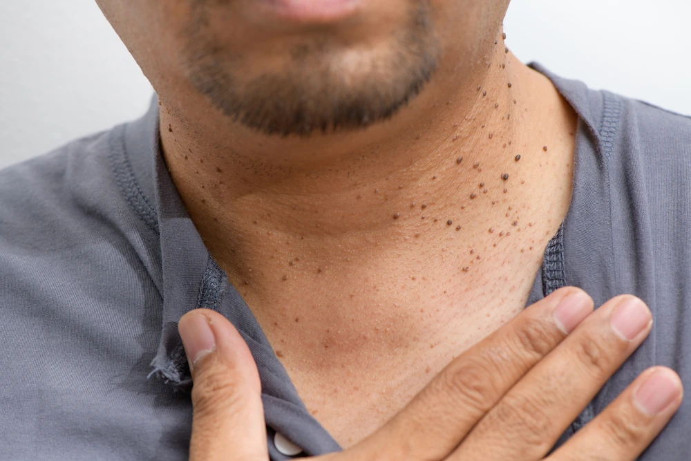 image of dermatofibroma removal Rickmansworth Rickmansworth