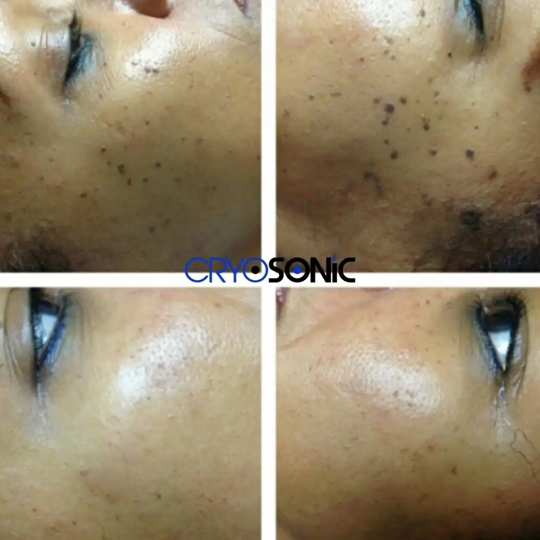 Why Skin Shows Pigmentation After Treatment Rickmansworth