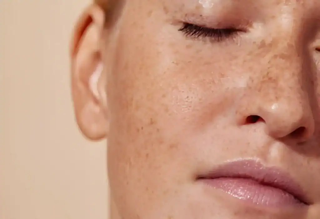 Ephelides Treatment Rickmansworth