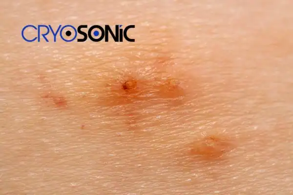 Image of Molluscum Contagiosum Treatment Rickmansworth Rickmansworth