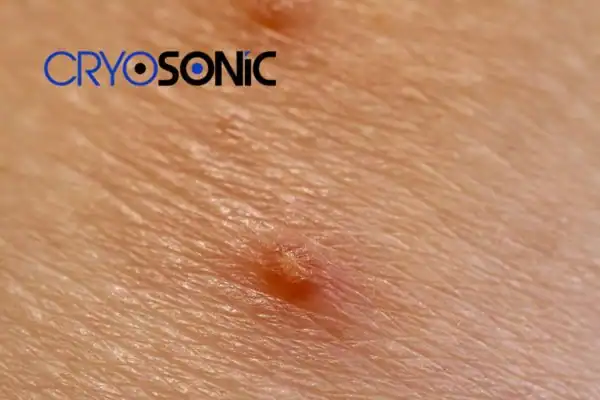 Molluscum Contagiosum Treatment Rickmansworth Rickmansworth