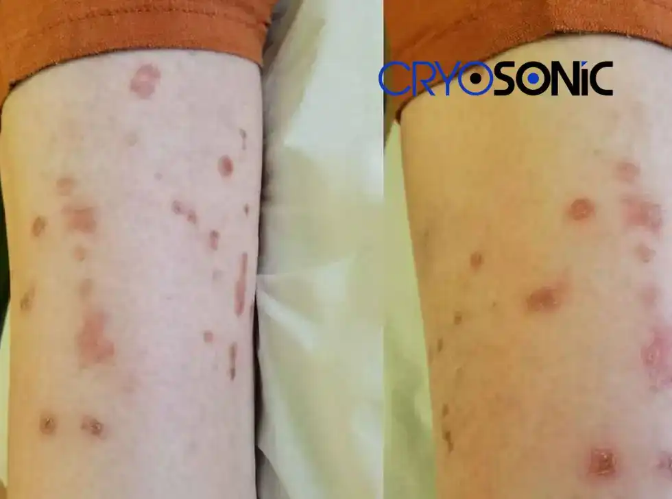 Recovery and Aftercare for Porokeratosis Treatment Rickmansworth Rickmansworth