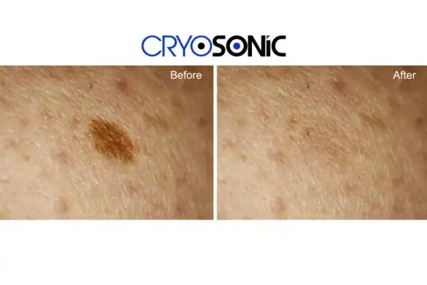 Before and after age spot removal Rickmansworth Rickmansworth