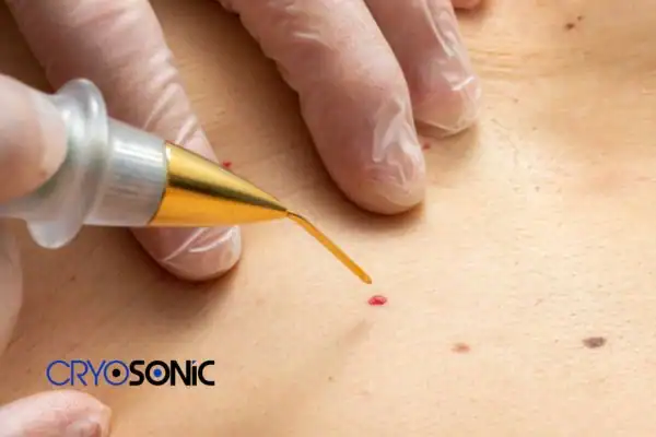 Image of cherry angioma removal Rickmansworth Rickmansworth