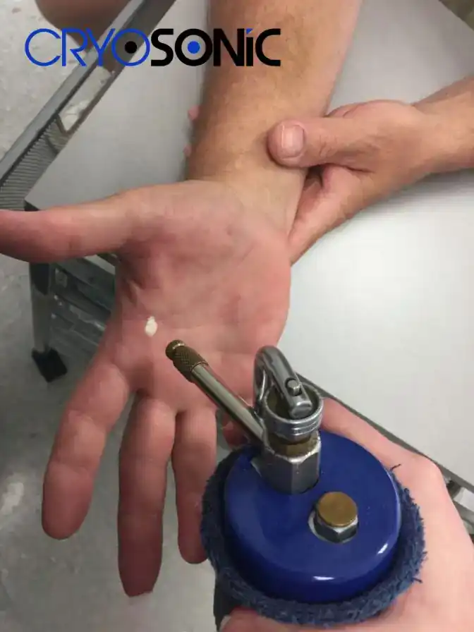 Temperature Differences: OTC vs Medical-Grade Cryotherapy Rickmansworth